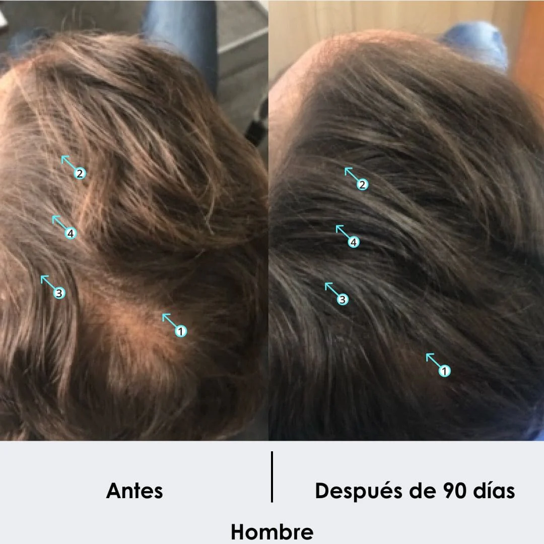 Tratamiento Anticaida + Crecimiento de Cabello Shampoo 250 ML - Image 4