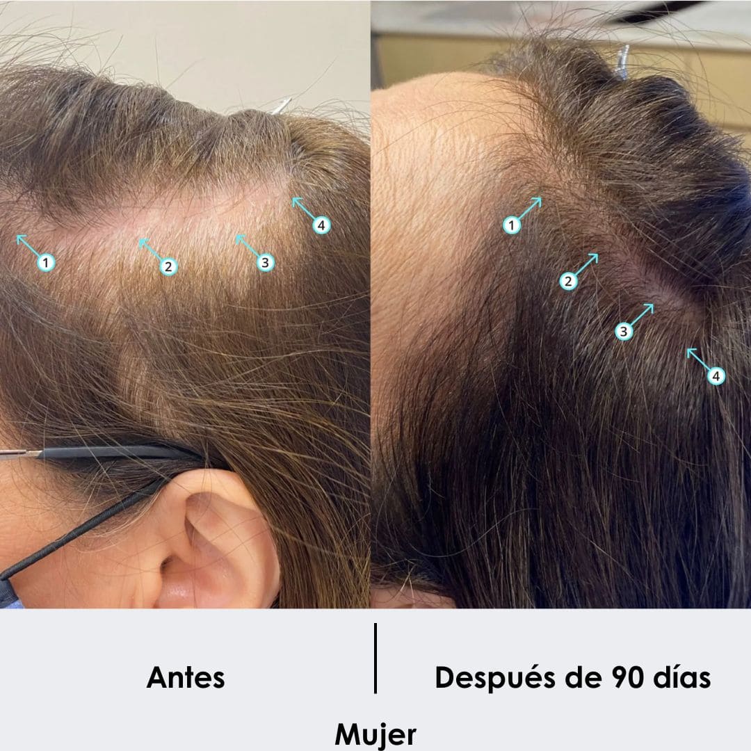 Tratamiento Anticaida + Crecimiento de Cabello Shampoo 250 ML - Image 5